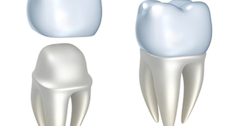 Does Every Cracked Tooth Need A Crown?