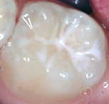 Surface of Tooth After Dental Sealant