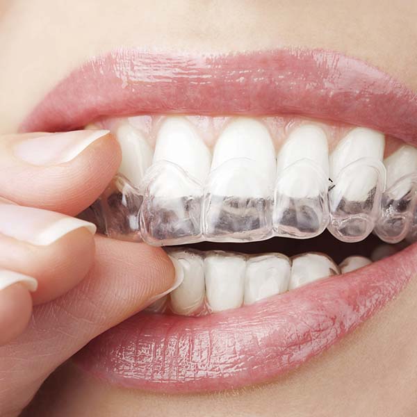 Closeup of clear aligners being put onto teeth